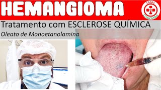 HEMANGIOMA Tratamento por esclerose química [upl. by Leeanne]