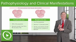 Calcific Aortic Stenosis  Pathophysiology and Clinical Manifestations [upl. by Daj]