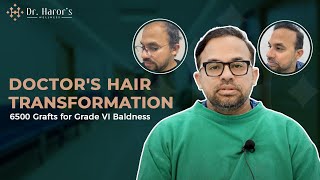 Doctor undergoes Hair Transplant  Reviews after 4 Years [upl. by Varuag972]