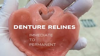 Immediate DenturePermanent Reline [upl. by Aicilic]