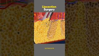 Liposuction Surgery [upl. by Mosier]