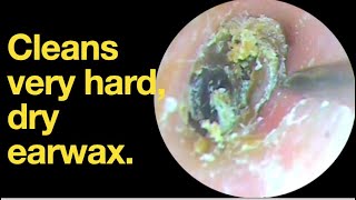 Cleans very hard dry earwax ear wax removal  ear cleaning  ASMR  relaxation  relax [upl. by Aneeb91]