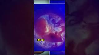 Man Discovers Living Twin in Swollen Stomach at 36 Years Old [upl. by Arot]