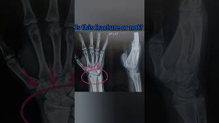 Is this fracture or not medicalimaging xray radiology [upl. by Mccreary]