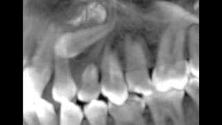 Canines incluses CBCT scan impacted cuspids orthodontie 123213 IT31 [upl. by Novi]