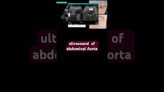 ultrasound of abdominal Aorta [upl. by Reuben664]