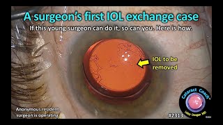 CataractCoach™ 2313 a surgeons first IOL exchange [upl. by Land]