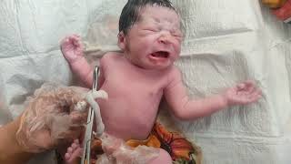 Learn How to Cut Umbilical cord of Newborn baby just after birth baby cute [upl. by Ane856]