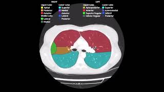 Bronchopulmonary segments in CT scan [upl. by Aisayn]