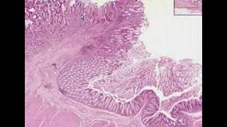 Histopathology ColonAdenocarcinoma [upl. by Abixah102]