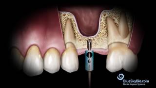 Advanced Simplified Sinus Lift Technique No Probe [upl. by Ramalahs]