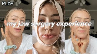 UNDERBITE JAW SURGERY  vlog  recovery days 114  before amp after [upl. by Oliva387]