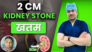 2 cm kidney stone खतम  RIRS से निकले 2cm Kidney stone  Patient from Siliguri West Bengal [upl. by Wiese]