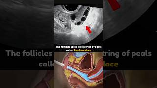 Polycystic Ovaries on Transvaginal Ultrasound 💕 pcos pcosinfertility pcoslifestyle [upl. by Callum]