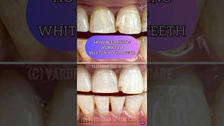 How Bleaching Works To Written Your Teeth [upl. by Charo713]