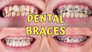 Braces time lapse  Teeth braces treatment  braces teeth transformation [upl. by Eglanteen]