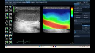 IQ 298 TESTIS HYPOECHIC STRAIN RATIO ELASTOGRAPHY ULTRASOUND HWD ECHOPAC ANALYSIS [upl. by Robina102]