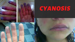 CYANOSIS  Causes Symptoms Types Treatment I What is cyanosis Peripheral and Central Cyanosis [upl. by Howland]