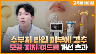 수부지 타입 주목✨ 모공피지여드름에 효과적인 시크릿 시술 조합 QnA🙌ㅣ엄종현의 엄친아클래스 [upl. by Jacklin]