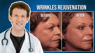 RESET Wrinkles Rejuvenation with Dr Adam Scheiner  Marilyns Testimonial [upl. by Sualokcin681]