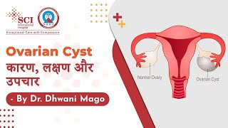 Ovarian Cyst कारण लक्षण और उपचार  Dr Dhwani Mago  SCI Hospital [upl. by Atnamas]