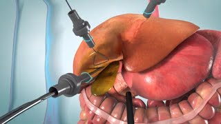 Laparoscopic and open cholecystectomy surgery animation [upl. by Quintilla]