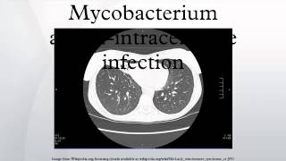 Mycobacterium aviumintracellulare infection [upl. by Linea453]