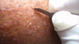 Popping Pustular Rash [upl. by Quickel]