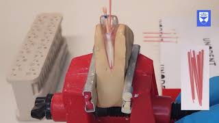 Endodontic treatment of the single rooted tooth Part 6 Obturation [upl. by Leahcimnhoj]