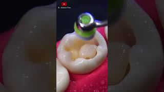 Eliminación de caries y restauración satisfying [upl. by Odey68]