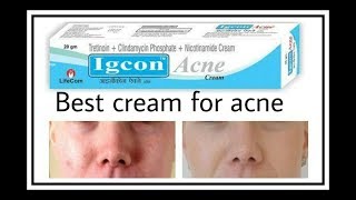 Acne Solutions IGcon Beauty Acne Cream  Best Cream For Acne  120rs  Priyanka Mebarak [upl. by Edan]