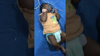 Child with microcephaly amp seizures  Pediatrics newborn shorts pediatrics seizures [upl. by Nebur583]