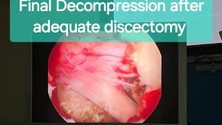 InterLaminar Endoscopic Discectomy Awake Spine Surgery Dr Rohit Thaker sciaticatreatment spine [upl. by Nedah703]