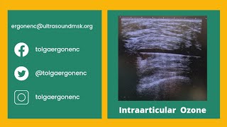 Intraarticular knee Ozone injection [upl. by Ybbob285]