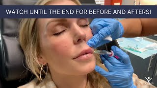 Volbella Lip Filler With Before and After Photos [upl. by Enawtna]