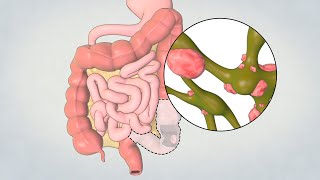 Patient Teaching Left Hemicolectomy Sigmoid Colectomy  TVASurg [upl. by Bennett]