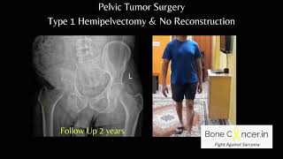 Treatment for Bone Cancer Chondrosarcoma Pelvic Tumour SurgeryHemipelvectomy Dr Srimanth B S [upl. by Rainie]