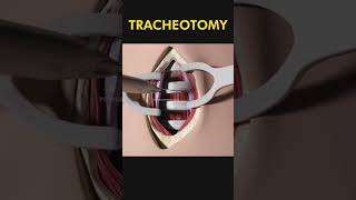 Tracheotomy 😷 explained [upl. by Adnik906]