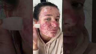 Best Fazit’s Pimple Patch Peels acneproneskin acne acnepositivity pimplepopper pimplepatch [upl. by Aehcsrop]