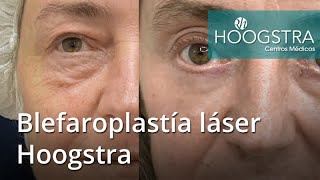 Blefaroplastía láser Hoogstra 22005 [upl. by Dene]