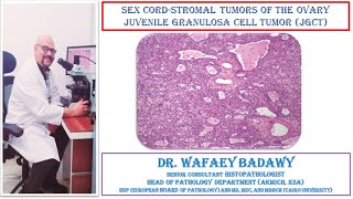 SEX CORD STROMAL TUMORS OF THE OVARY JUVENILE GRANULOSA CELL TUMO BY DR WAFAEY BADAWY [upl. by Margot]