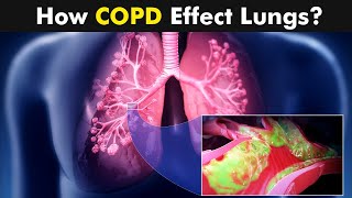 Chronic Obstructive Pulmonary Disease COPD  Symptoms Causes And Treatment UrduHindi [upl. by Ineslta970]