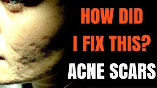 How to treat acne scars  Dermatologist explains [upl. by Nosnev]