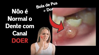 5 Sinais de que o Seu Tratamento de Canal deu MUITO ERRADO [upl. by Ahsatal]