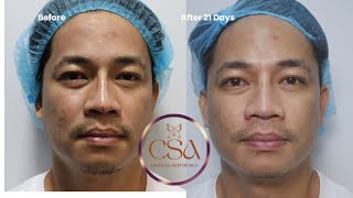 Acne scar treatment using Eladerm RFMN [upl. by Aidas]