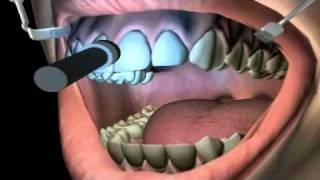 What is Teeth Bleaching [upl. by Hgielyk]