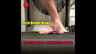 How Overpronation Causes Achilles Tendonitis [upl. by Elnora817]