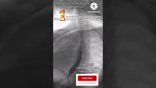 Barium swallow normal oesophagus constriction radiology xray mbbsstudent shorts [upl. by Uahc]