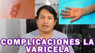 COMPLICACIONES DE LA VARICELA  DR APARI [upl. by Reltuc]