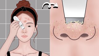 Skin Care Animation丨Pimple popping丨Acne treatment丨Mengs Stop Motion [upl. by Jeremias]